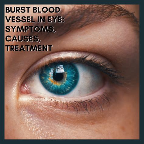 Popped Blood Vessel in Eye: Causes, Treatment,。